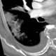 Thrombosis of the pulmonary vein: CT - Computed tomography